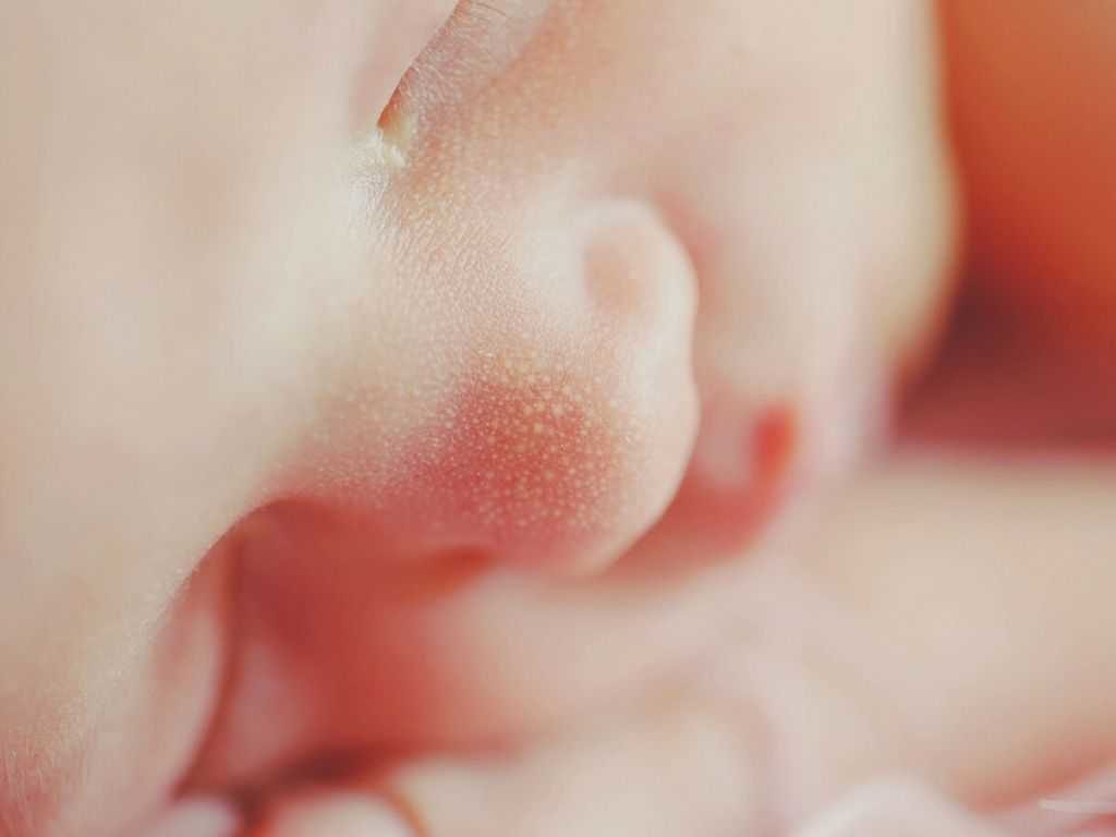 problemy skórne noworodka